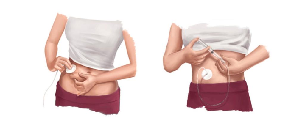 Bei der subkutanen Gabe kann die Verabreichung der Immunglobuline unter die Haut auch von Hand, d. h. ohne eine Pumpe erfolgen. Diese Art der Anwendung wird als Manual Push bezeichnet.